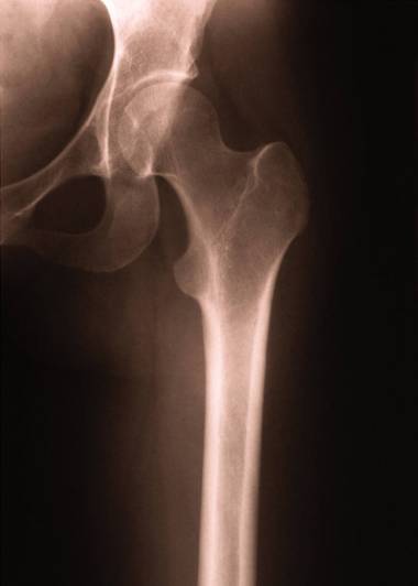 Hip xray